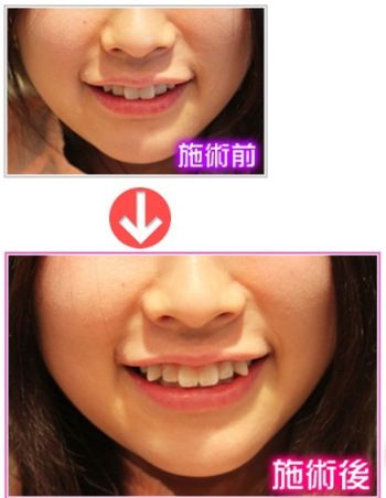 Why Japanese women go for fake crooked teeth - Japan Today
